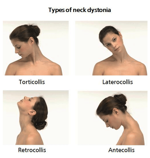 <p>What is <strong>dystonia?</strong></p>
