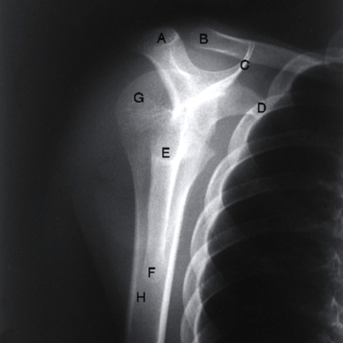 <p>coracoid process</p><p>3 multiple choice options</p>