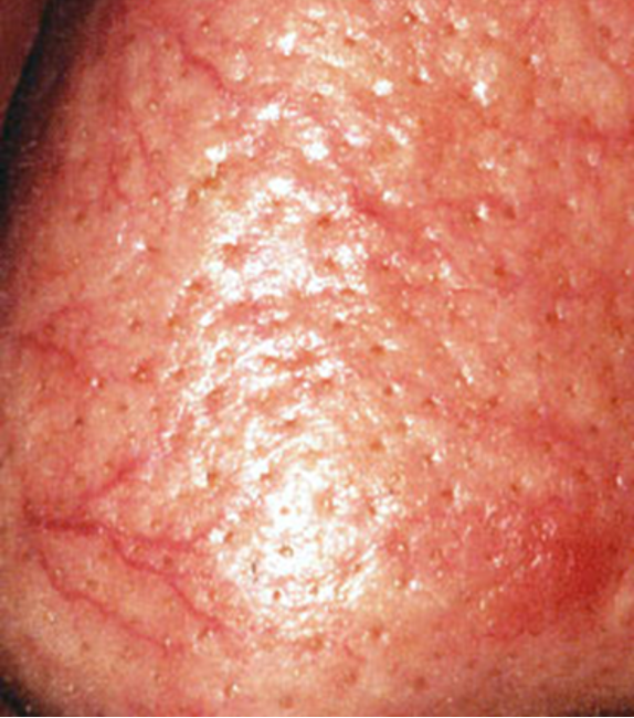 <p>small enlarged blood vessels near surface of skin often nose, cheeks, and chin; usually only mms in size; sign of chronic alcoholism </p>