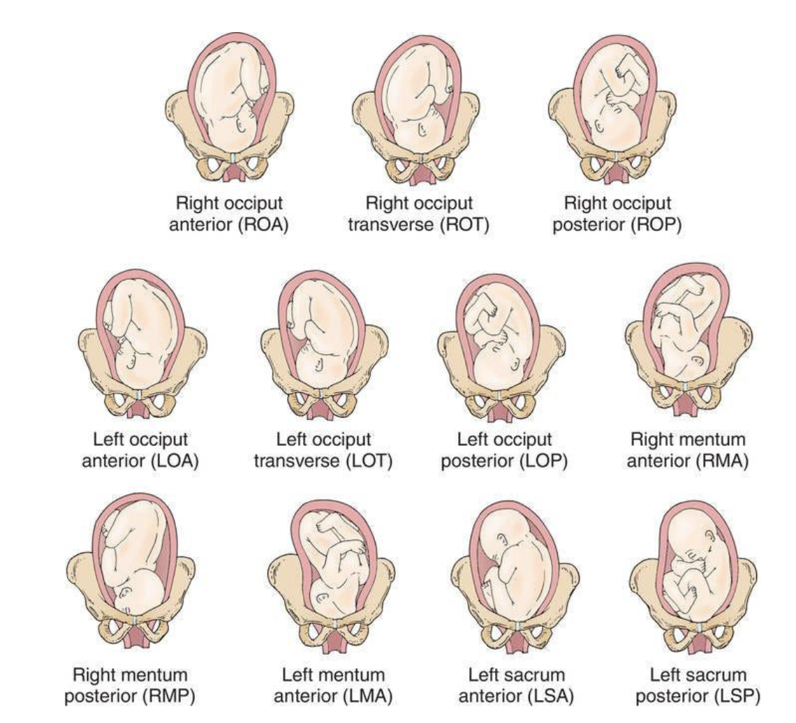 <p><strong>hird letter — Anterior (A), Posterior (P), or Transverse (T)</strong> </p><p>This shows <strong>which way the fetal reference point is facing</strong> relative to the mother’s pelvis (front or back).</p><p> </p><ul><li><p><strong>A</strong> = toward <strong>anterior</strong> (mother’s front)</p></li><li><p><strong>P</strong> = toward <strong>posterior</strong> (mother’s back)</p></li><li><p><strong>T</strong> = <strong>transverse</strong>, facing sideways</p></li></ul><p> </p>