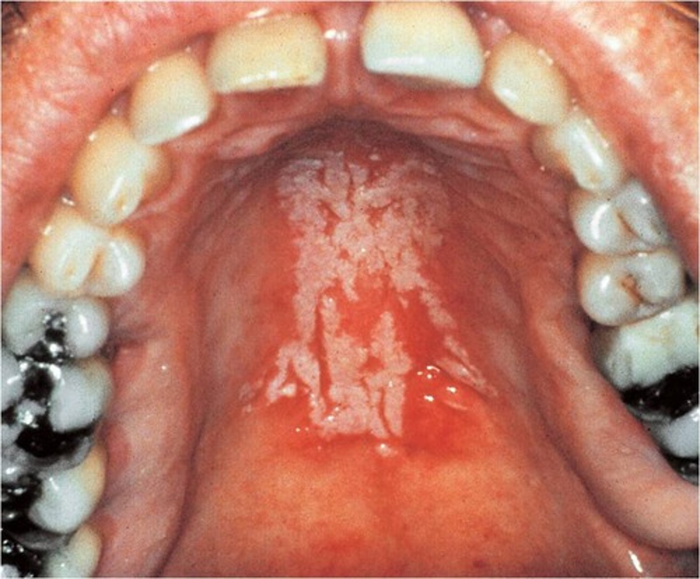 <p>Infection of the skin mouth (also called thrush) or vagina caused by the yeast type fungus candida albicans. candidiasis normally present in the mucous membranes, overgrowth causes an infection. esophagus candida they cyst is often seen in patients with AIDS (acquired immunodeficiency syndrome)</p>