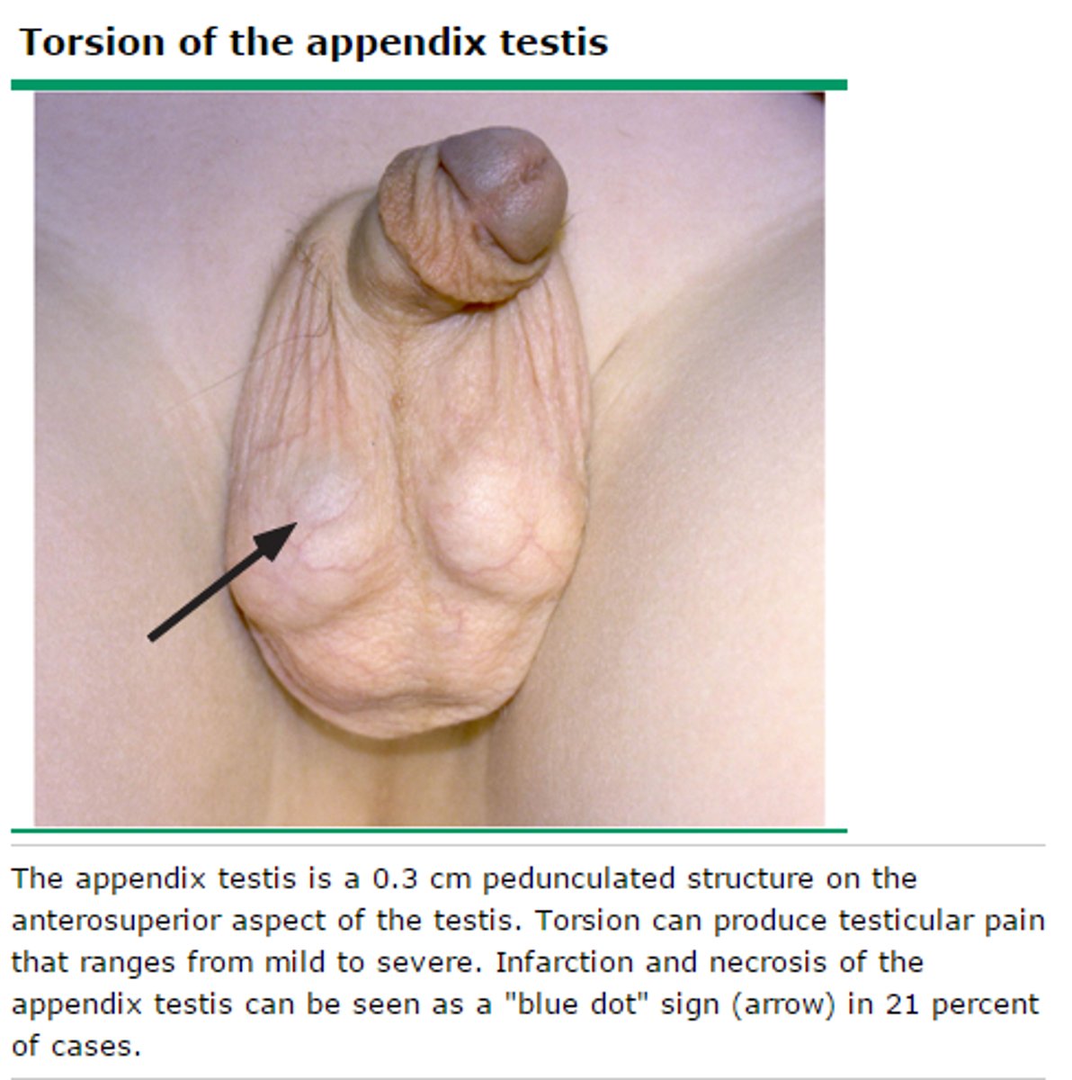 <p>-cremasteric reflex is usually preserved</p><p>-blue dot sign</p><p>A hard, tender nodule may be palpable on the upper pole of the testicle, and a blue discoloration</p>
