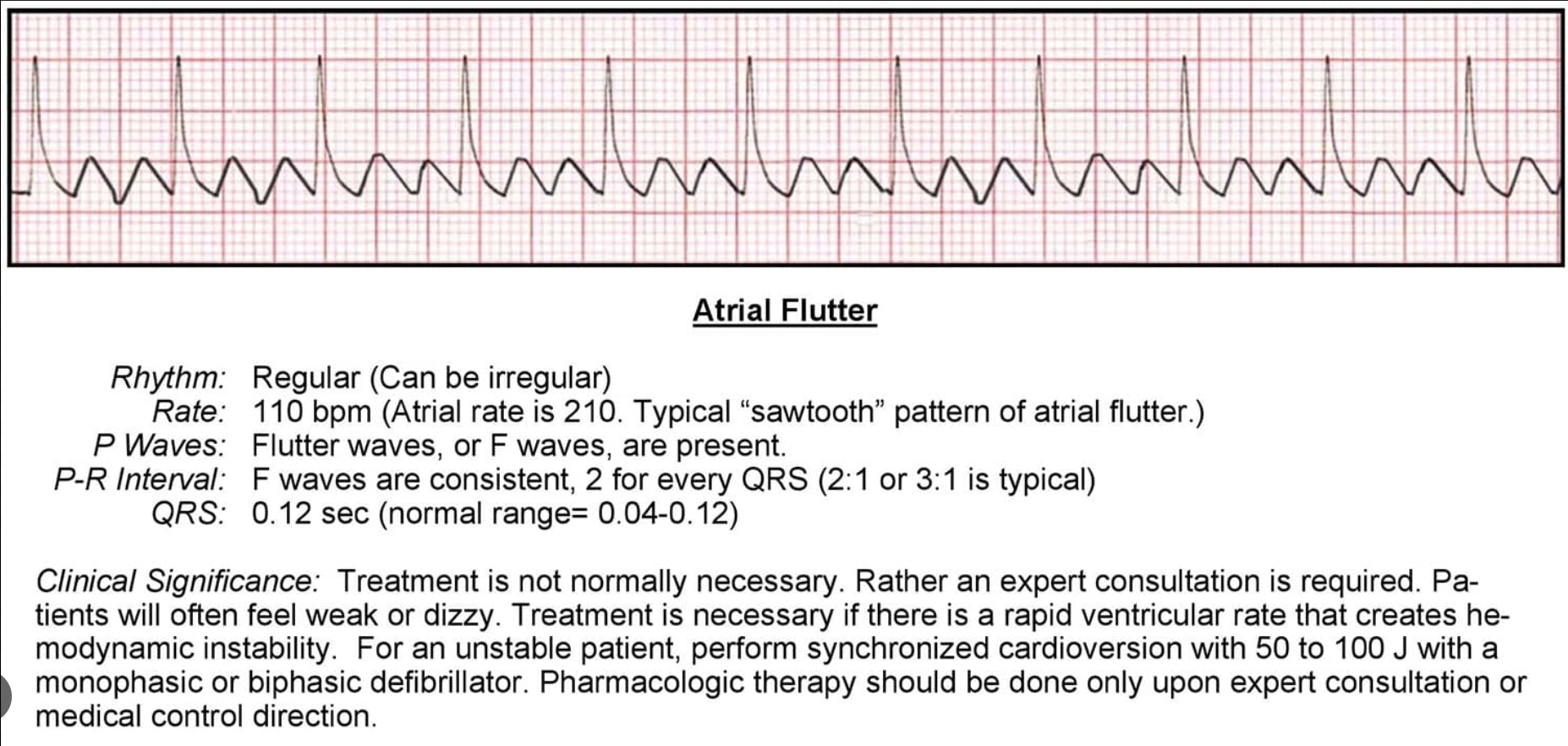 <p>In which stimulus formation disorder(arrhthymia)can you see characteristic F waves in sawtooth pattern?</p>