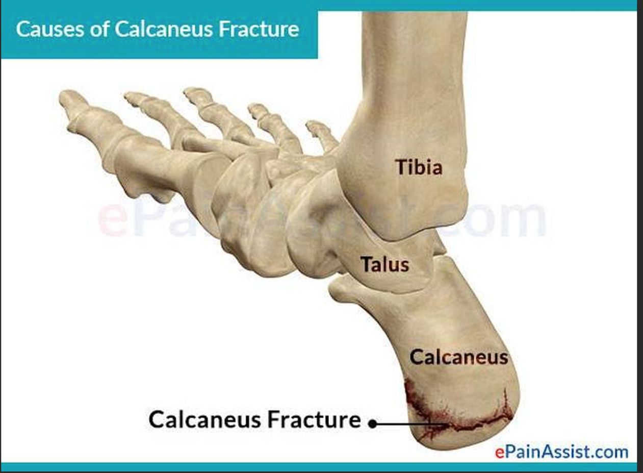 <p>Calcaneus</p>