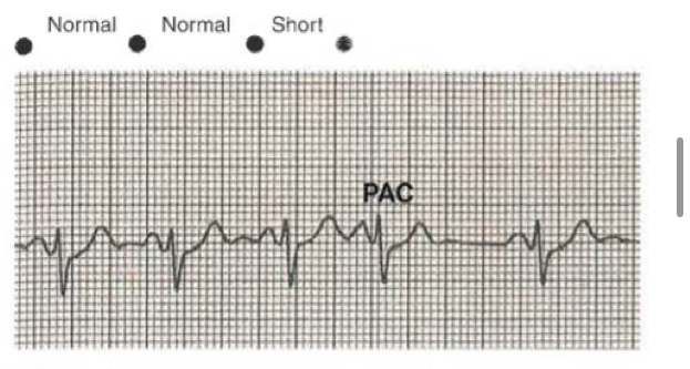 <p>Early, premature beat</p><p>This impulse arises from somewhere above the ventricles but not the SA node</p>