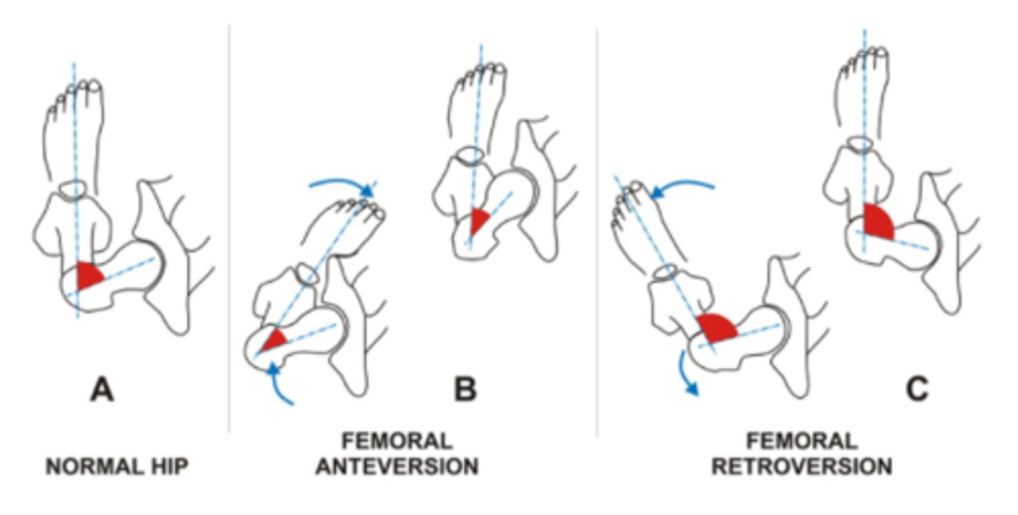 <p>Anteversion</p><p>Hip IR, decreases joint stability</p><p>Retroversion</p><p>Hip ER, increases joint stability</p>