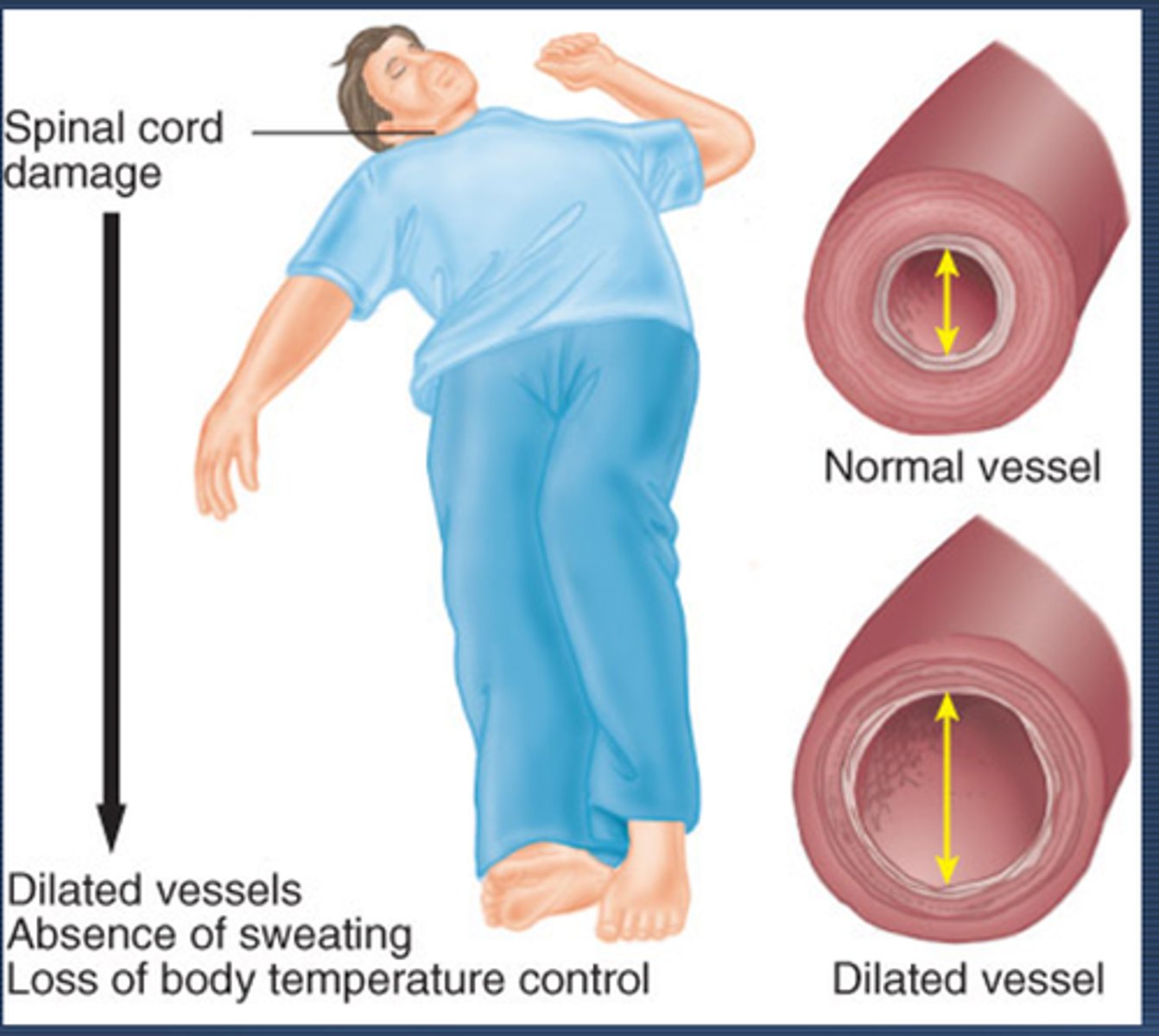 <p>cervical or upper thoracic injuries</p><p>- In addition to spinal shock.</p><p>- caused by absence of sympathetic activity and unopposed parasympathetic tone mediated by an intact vagus nerve</p><p>- vasodilation</p>