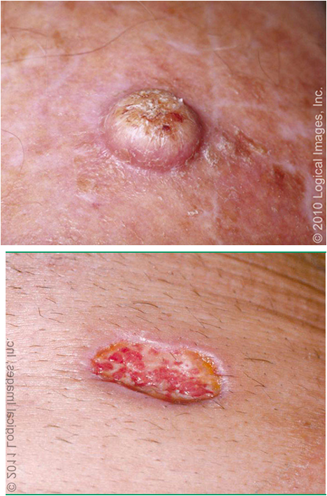 <ul><li><p>well differentiated lesions → indurated, firm, hyperkeratotic papules, plaques, nodules</p></li><li><p>poorly differentiated → fleshy, granulomatous papules, nodules; w/ ulceration, hemorrhage, necrosis</p></li><li><p>slowly evolving → tissue destruction; can metastasize 1-3 yrs after initial dx; can cause burning/paresthesias/visual changes if neural invasion</p></li></ul><p></p>