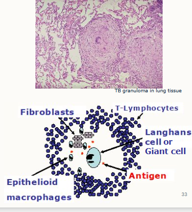 <ul><li><p>aggregates of chronically stimulated inflammatory cells</p></li><li><p>millimetre size range in tissue (can be detrimental in tissues such as lung)</p></li><li><p>confluent, forming larger areas</p></li></ul><p>essential components are:</p><ul><li><p>collections of modified macrophages called epithelioid cells, which when merged together (more than one epithelioid cell) forms a Giant cell/Langhans cell</p></li><li><p>a surrounding zone of lymphocytes.</p></li></ul><p></p>