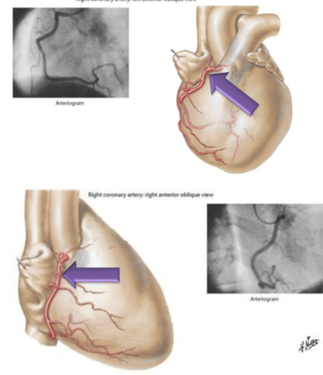 <p>What 2 structures does Right Coronary Artery give off?</p>