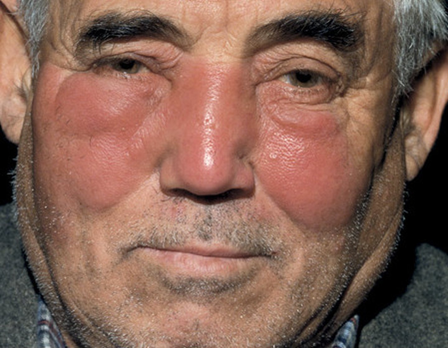 <p>painful superficial cellulitis with a dermal lymphatic involvement that frequently involves the face</p>