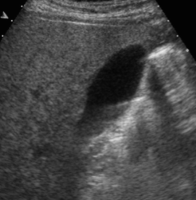 <ul><li><p><span style="background-color: transparent;">Caused by echoes from a <strong><u>strong</u></strong> reflector outside of the central beam</span></p><ul><li><p><span style="background-color: transparent;">Most of the intensity is in the main sound beam, but sometimes additional beams travel out in directions not included in the main beam</span></p></li></ul></li><li><p><span style="background-color: transparent;">Occur with single element transducers</span></p></li><li><p><span style="background-color: transparent;">Reduced with harmonics</span></p></li><li><p><span style="background-color: transparent;">Results in a structure being shown as being laterally displaced or going out laterally</span></p></li><li><p><span style="background-color: transparent;">In the image, the gallbladder is located behind the bowel and is not visible. The black oval next to the bowel is this artifact mimicking the gallbladder.</span></p></li></ul><p></p>