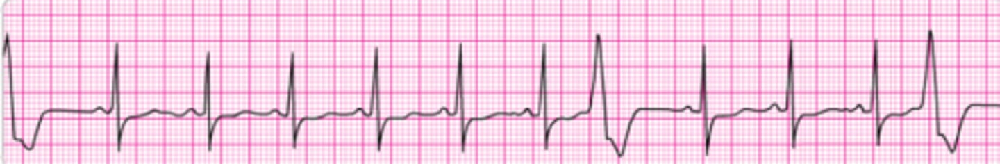 <p>A patient in the emergency department develops recurrent chest discomfort (8/10) suspicious for ischemia. His monitored rhythm becomes irregular as seen above. Oxygen is being administered by nasal cannula at 4 L/min, and an IV line is in place. Blood pressure is 160/96 mm Hg. There are no allergies or contraindications to any medication. You would first order:</p><p>1. Sublingual nitroglycerin 0.4 mg.</p><p>2. Morphine sulfate 2 to 4 mg IV.</p><p>3. Lidocaine 1 mg/kg IV and infusion 2 mg/min.</p><p>4. Amiodarone 150 mg IV.</p><p>5. IV nitroglycerin initiated at 10 mcg/min and titrated to patient response.</p>