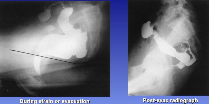 <p>What is this x-ray demonstrating?</p>
