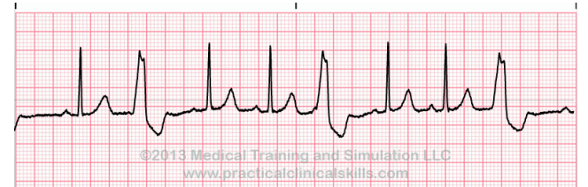 <p>What can be seen here?</p><p>-Refers to the presence of a PVC after 2 normal beats</p>