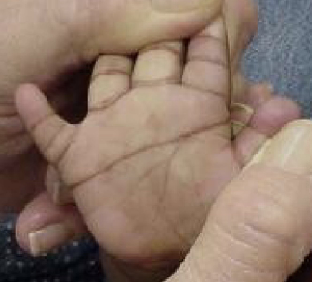 <p>- Simian crease (palm)</p><p>- Short neck</p><p>- Clinodactly (curving) of 5th finger</p><p>- Wide gap between 1st and 2nd toe</p>