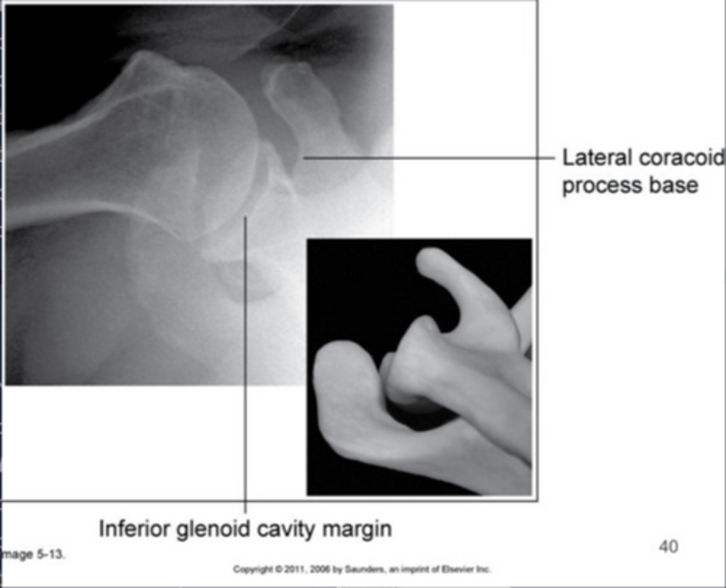 <p>Not enough CR angle (less than 30°)</p>
