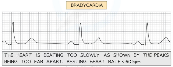 <ul><li><p>heart beat too slow</p></li><li><p>peaks of ECG too far apart</p></li></ul>