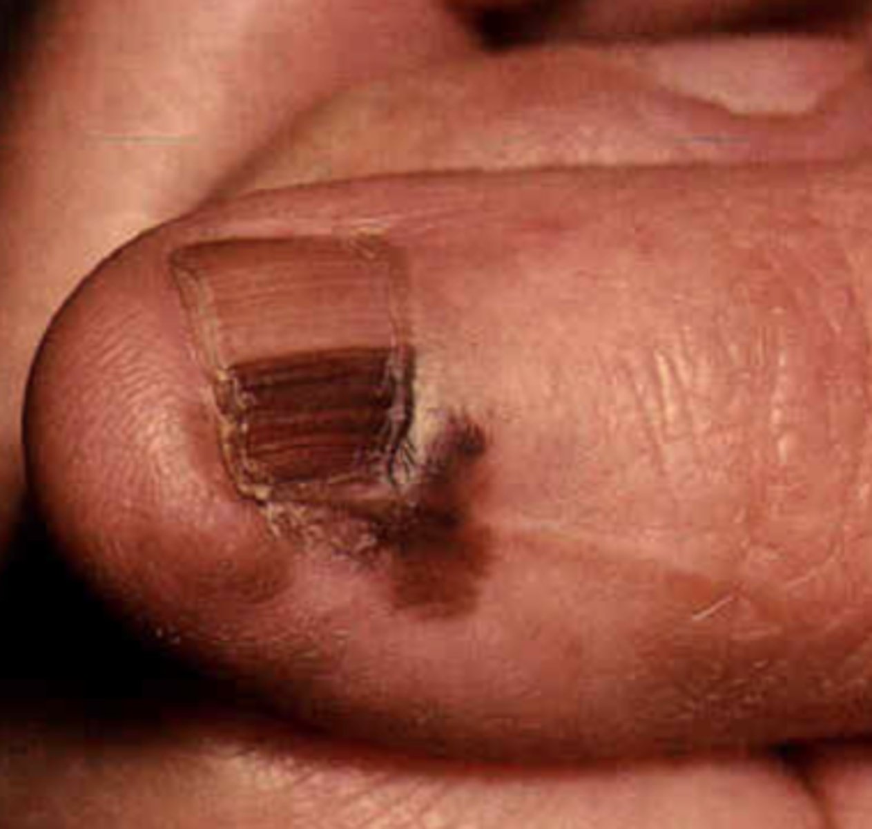 <p>Dark streak under the nail </p><p>Dark streak under the nail that involves the nail fold </p><p>+ Hutchenson's sign </p>