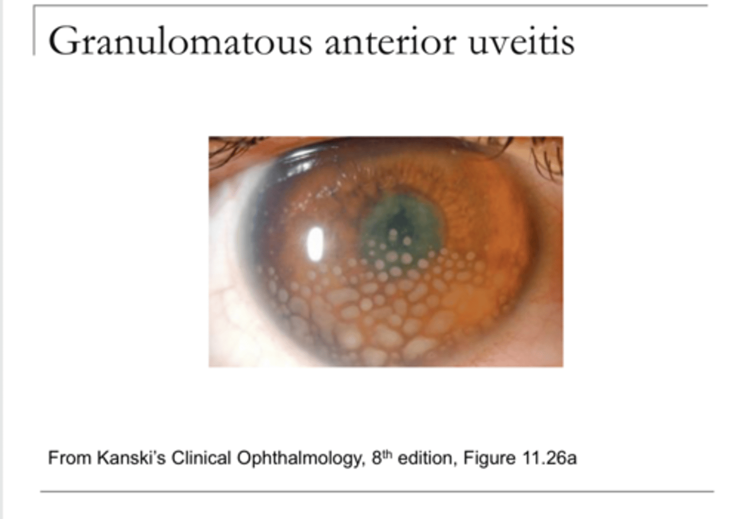 <p>Granulomatous Anterior Uveitis (Pic)</p>
