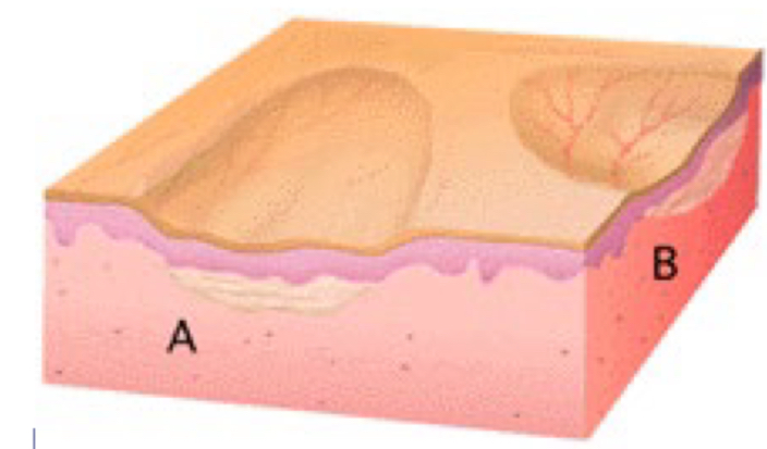 <p>what type of lesion is depicted</p>