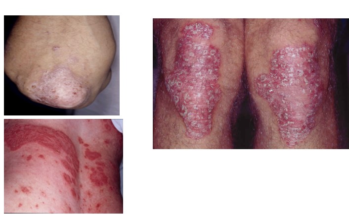 <p>Psoriasis </p>