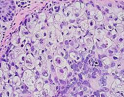 <p>Sebaceous carcinoma</p><p>N/E:</p><p>Localized or diffuse swelling of the tarsus.</p><p>M/P:</p><p>Tumor cells with sebaceous differentiation (cells with clear, foamy cytoplasm that resembles sebocytes).</p>