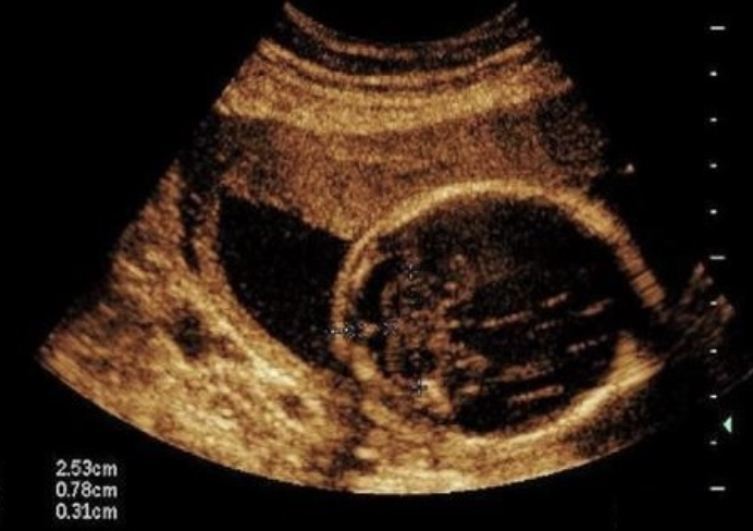 <p>where is the placenta</p><p>a) low lying</p><p>b) posterior</p><p>c) anterior</p><p>d) fundal</p>
