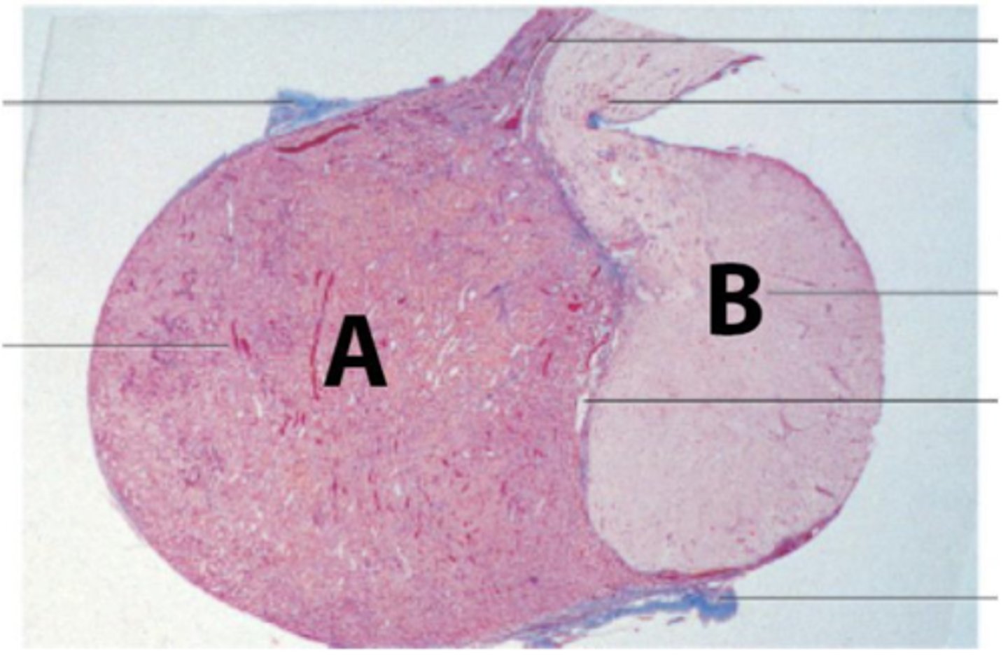 <p>The patient is suffering from Sheehan's syndrome, which is characterized by partial or complete necrosis of this organ (shown in the picture) in women with severe blood loss and hypotension during delivery.</p><p>What is at B? What is the embryological origin?</p>