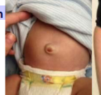 <p>what type of hernia is that</p>