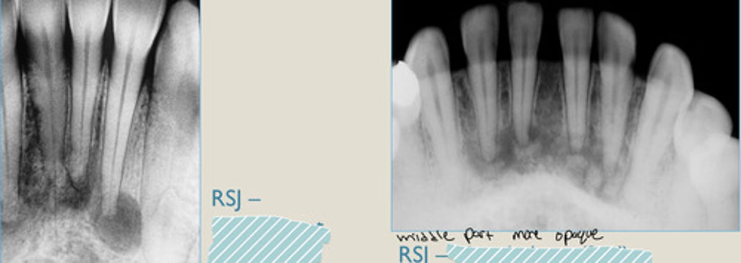 <p>Radiolucent rim</p><p>Which ones the 1st and 2nd phase?</p>