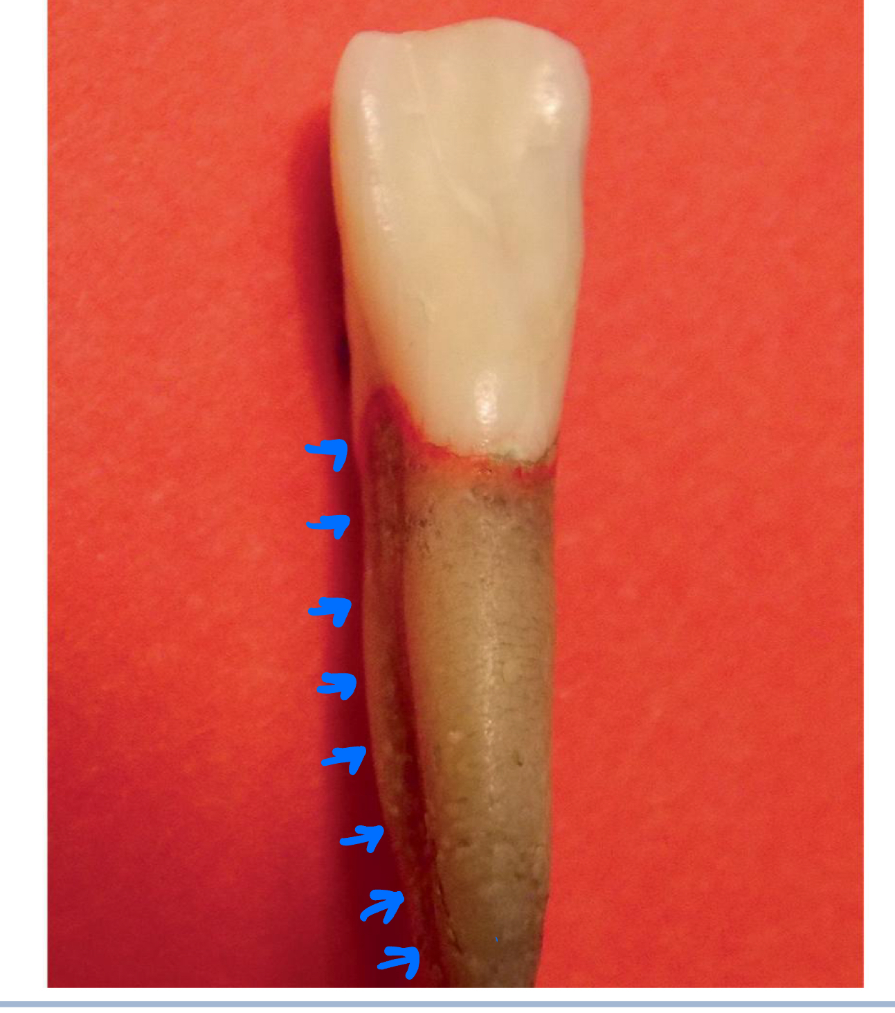 <p>YES, both mesial and distal</p><p>More prominent than in maxillary</p>