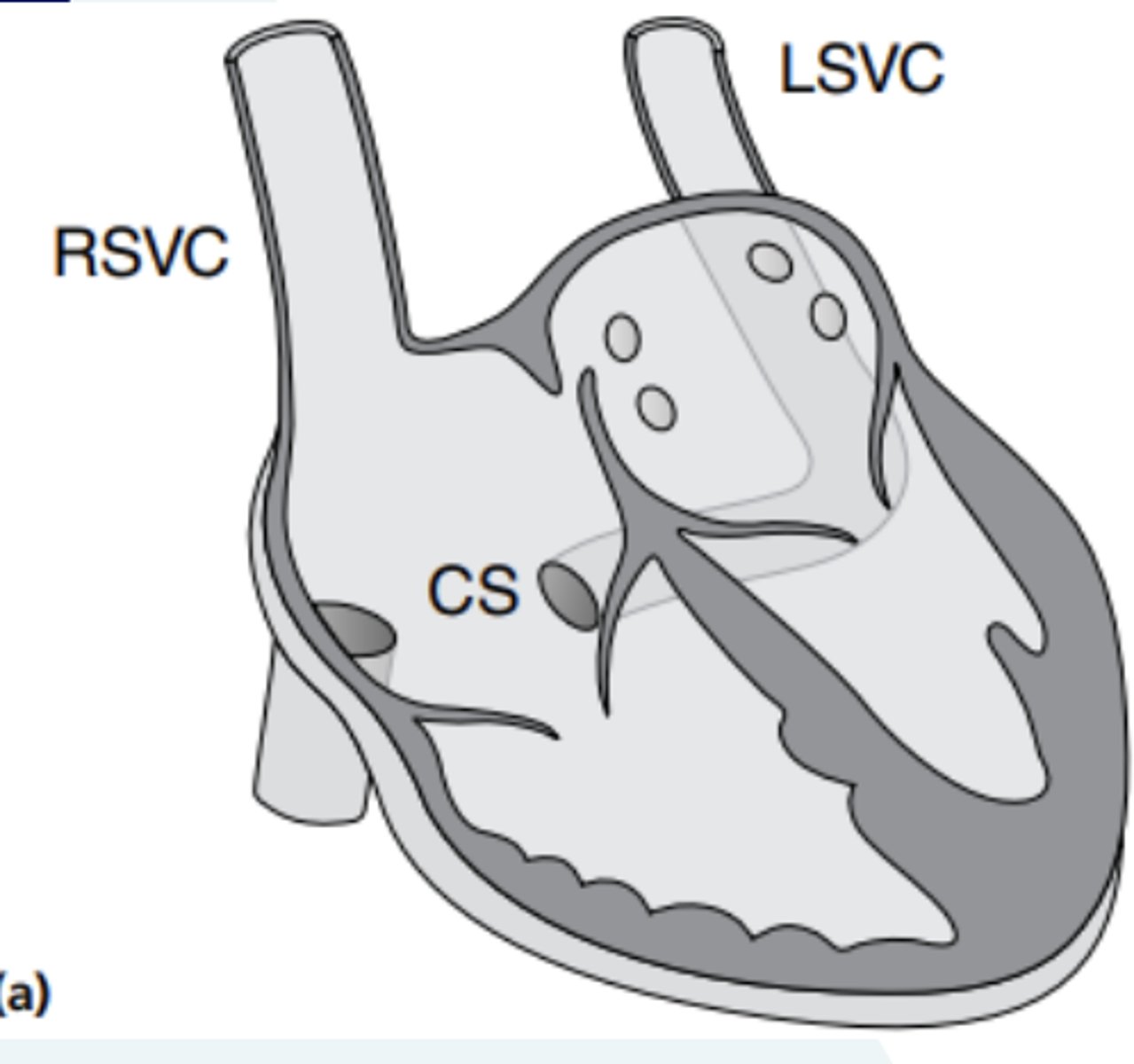 <p>because there is failure of regression of the left anterior cardinal and left common cardinal veins</p>