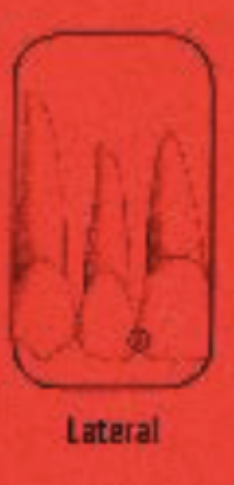 <p>The lateral incisor</p>