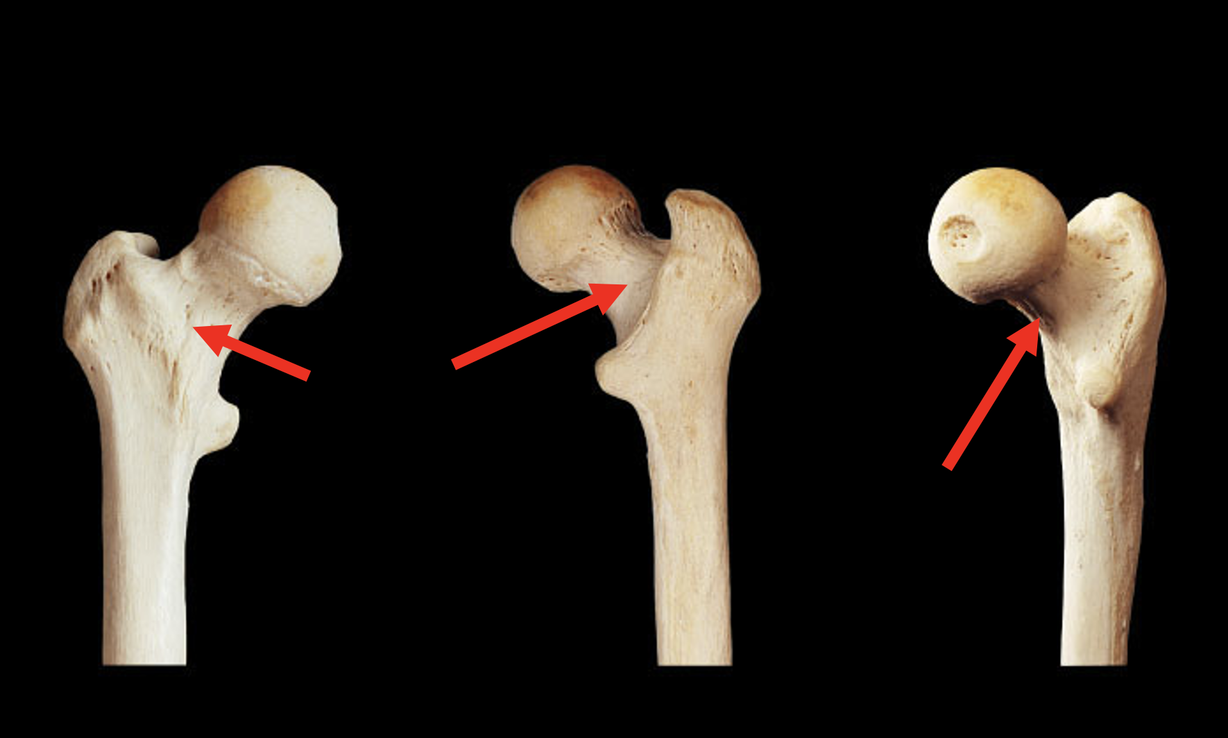 <p>Name this region of the femur</p>