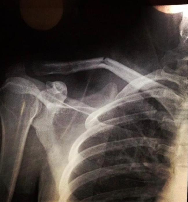 <p>greenstick fracture is this type of fracture, most commonly found in children </p>