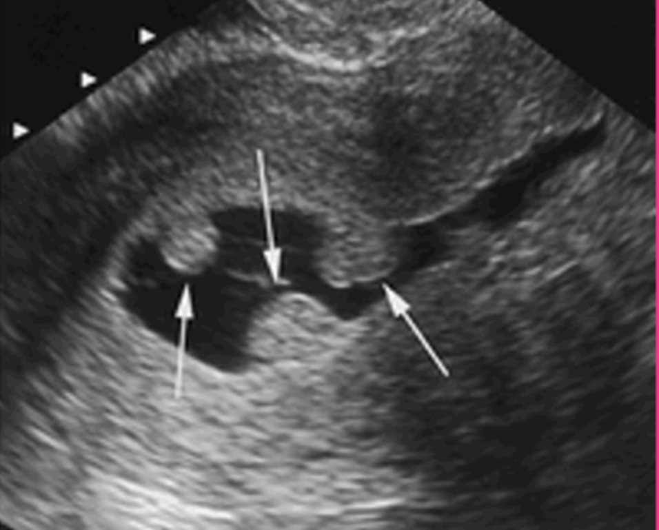 <p>What is an endometrial polyp?</p>