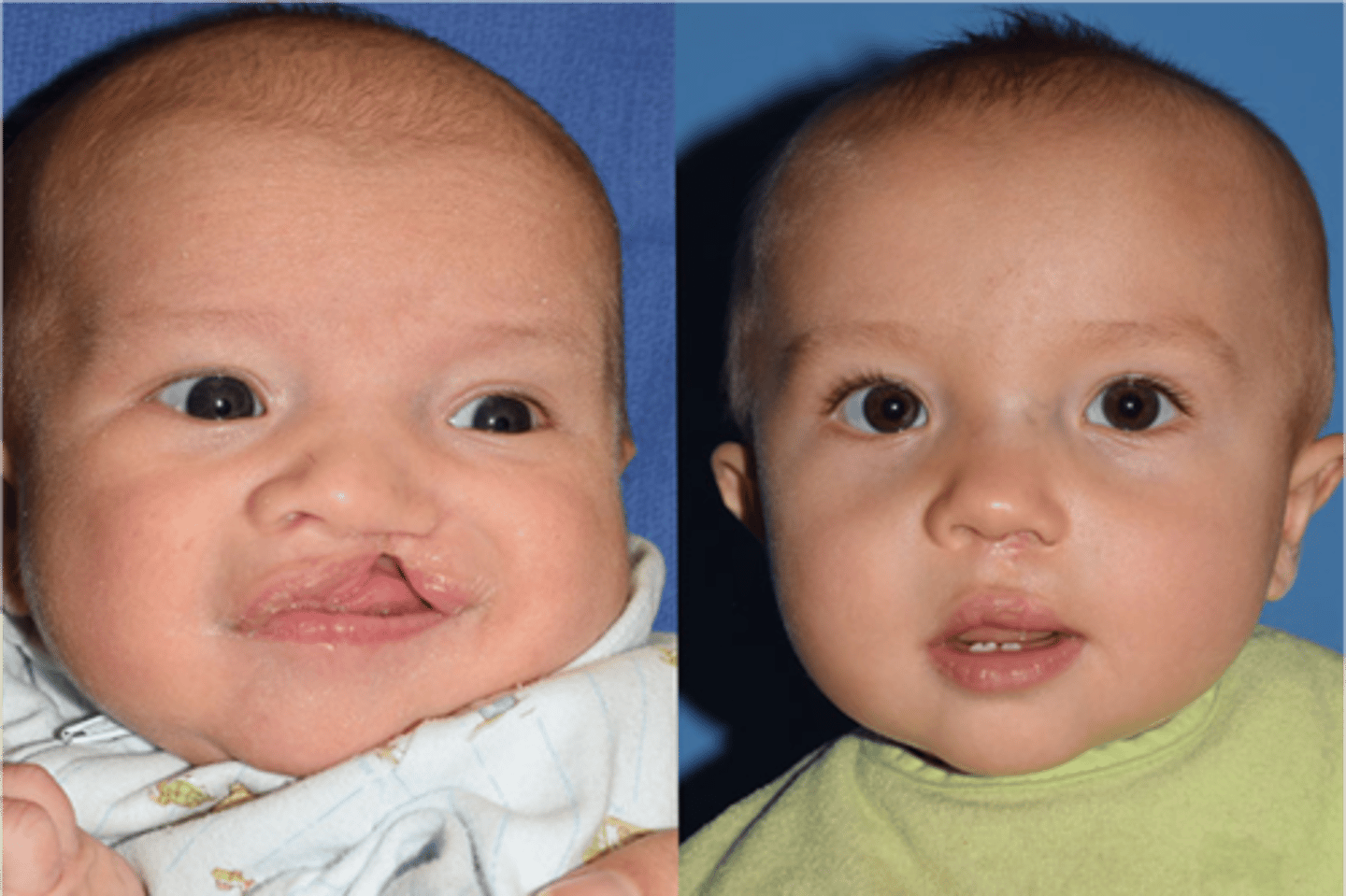 <p>Cleft palate and lip treatment</p>