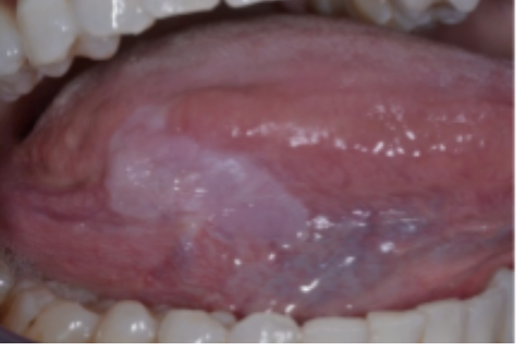 <p><span>A 53-year-old male presents with a white patch on the right lateral border of his tongue present for 3 months. The lesion is non-painful, slightly raised, and cannot be scraped off. He has a 30-year history of smoking 1 pack/day. There is no trauma history and no cervical lymphadenopathy.</span></p><p><span>oral leukoplakia </span></p><p><span>oral lichen planus </span></p><p><span>candida </span></p><p><span>frictional keratosis </span></p>