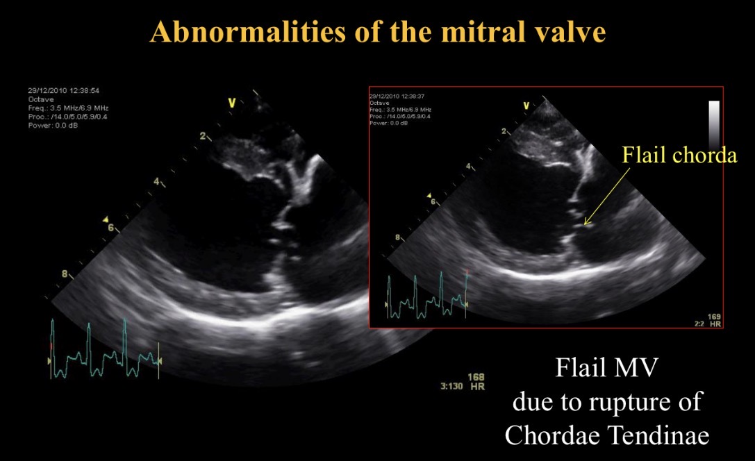 <p>Ruptured chordae tendinae in mitral valve disease </p>