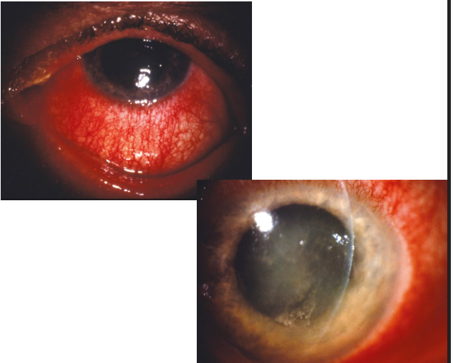 <ol><li><p>• Hyperemia</p></li><li><p> chemosis</p></li><li><p>lid or periorbital swelling</p></li><li><p> mucous discharge</p></li><li><p><strong><mark data-color="yellow" style="background-color: yellow; color: inherit"><u>follicular </u></mark><u>palpebral conjunctival reaction</u></strong></p></li><li><p><strong><u> and itching</u></strong></p></li></ol><p></p>