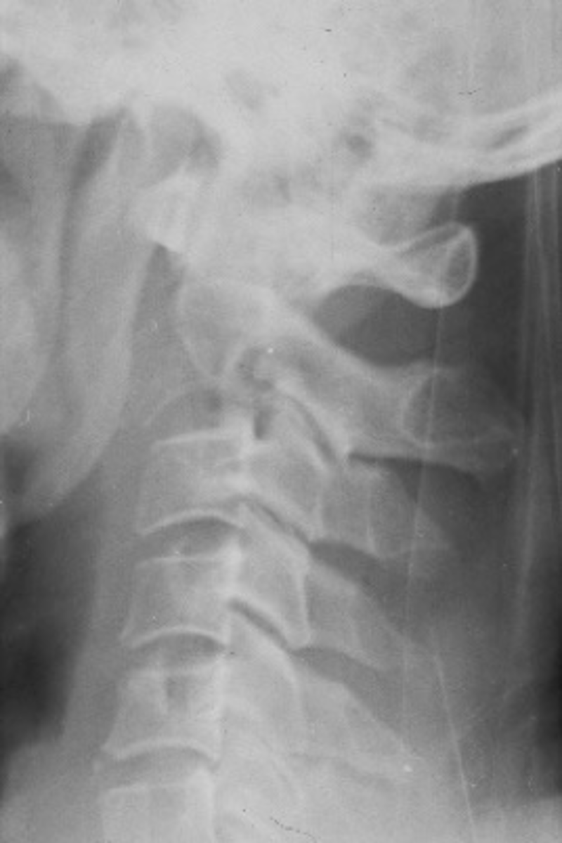 <p>ID radiologic pattern of disease</p>