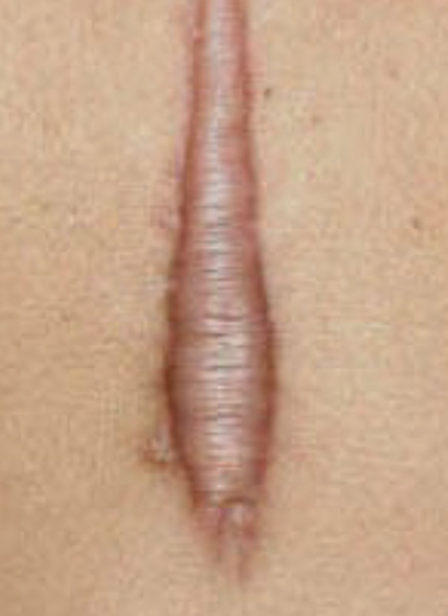 <p>Also raised, but grow past the site of the wound</p><p>- Overtaking normal, healthy tissue</p><p>- BEYOND borders of wound!</p>