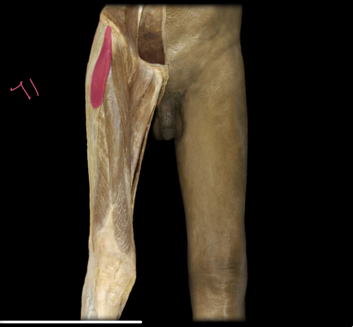 <p>Tensor fasciae latae.</p>