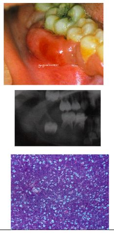 <p><span style="background-color: transparent; font-family: "Times New Roman", serif;"><u>African Type:</u></span></p><p><span style="background-color: transparent; font-family: "Times New Roman", serif;">*<strong>Primarily involves jaw bones (most often maxilla</strong>) with secondary visceral involvement</span></p><p><span style="background-color: transparent; font-family: "Times New Roman", serif;"><u>American Type:</u></span></p><p><span style="background-color: transparent; font-family: "Times New Roman", serif;">*<strong>Primarily presents as abdominal swelling</strong> - only 15% jaw involvement → <strong>Jaw involvement in both types = rapidly growing mass, teeth become mobile and can exfoliate</strong></span><br></p><p><span style="background-color: transparent; font-family: "Times New Roman", serif;"><u>Radiograph</u>:</span></p><p><span style="background-color: transparent; font-family: "Times New Roman", serif;"><strong>*Destructive, ragged, “moth-eaten” radiolucency</strong></span></p><p><span style="background-color: transparent; font-family: "Times New Roman", serif;"><strong>*Teeth “floating in air”</strong></span><br></p><p><span style="background-color: transparent; font-family: "Times New Roman", serif;"><u>Histology</u>:</span></p><p><span style="background-color: transparent; font-family: "Times New Roman", serif;">*Diffuse small lymphocytes with <strong>“starry sky”</strong></span></p><p><span style="background-color: transparent; font-family: "Times New Roman", serif;"> - sky = lymphocytes</span></p><p><span style="background-color: transparent; font-family: "Times New Roman", serif;"> - stars – macrophages</span></p>