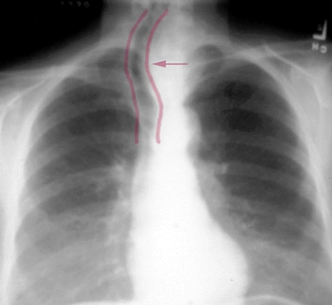 <p>a shifting of the trachea to either side of the midline of the neck caused by pneumothorax</p>