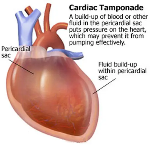 <p>pericardial cavity becomes overly filled with fluid (pericardial fluid or blood)</p><p></p>