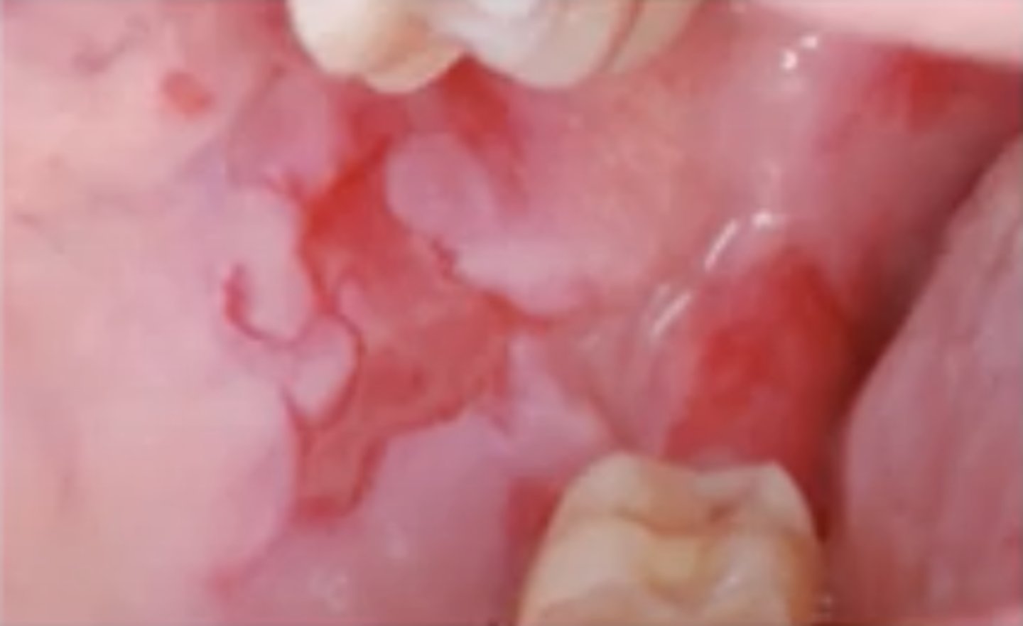 <p>Hint: Painful and long persisting superficial and ragged erosions affecting mucosal surfaces</p>