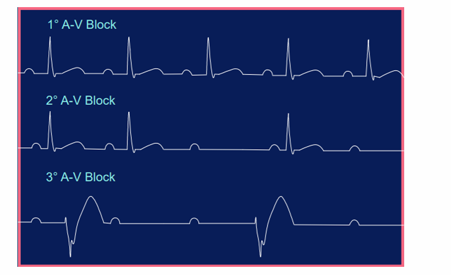 <p>a disorder in the heart's rhythm due to a fault in the natural pacemaker</p>