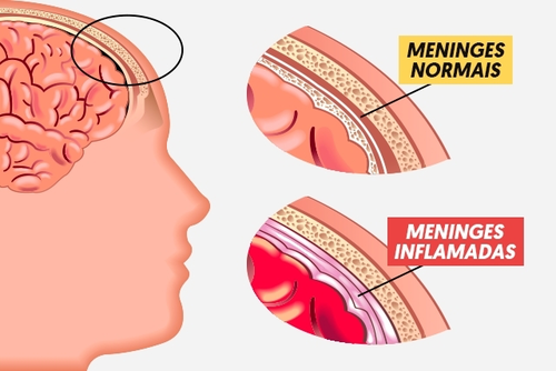 Meningococcal